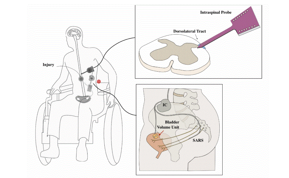Imagen: Arquitectura conceptual del sistema de estimulación ligado a la vejiga (BLISS) propuesto (S. Zhong et al., IEEE Transactions on Neural Systems and Rehabilitation Engineering (2026). DOI: 10.1109/tnsre.2026.3675572)
