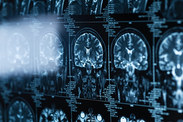 Imagen: Un modelo de aprendizaje profundo multitarea utiliza una resonancia magnética de referencia única y datos demográficos para predecir puntuaciones cognitivas sin pruebas cognitivas de referencia (crédito de la imagen: 123RF) Imagen: Un modelo de aprendizaje profundo multitarea utiliza una resonancia magnética de referencia única y datos demográficos para predecir puntuaciones cognitivas sin pruebas cognitivas de referencia (crédito de la imagen: 123RF)