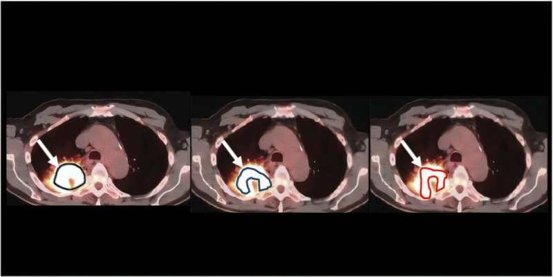 Imagen: En este ejemplo, tres métodos de delimitación de tumores producen diferentes estimaciones del volumen del tumor a partir de la misma imagen clínica. Sin conocer el verdadero volumen del tumor, es difícil determinar qué método de entre ellos funciona mejor. La técnica NGSE-Corr propuesta proporciona una manera de comparar dichos métodos sin requerir conocimiento del valor real. (Crédito de la imagen: laboratorio Jha/WashU)
