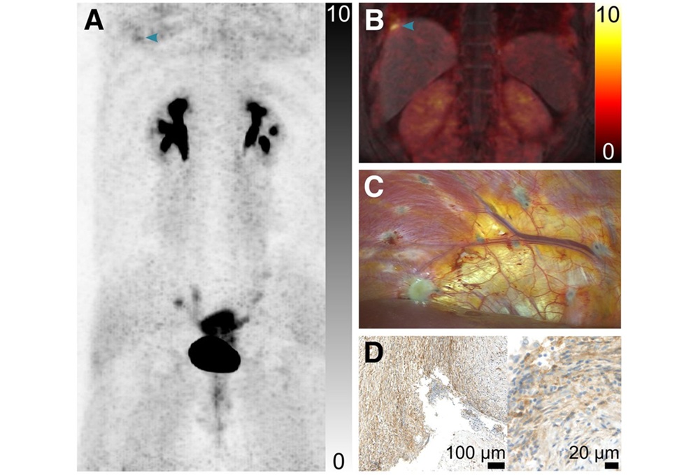 Imágenes de la paciente T1, que tenía dolor en el hombro derecho dependiente del ciclo menstrual. (A) Las imágenes de proyección de máxima intensidad muestran hallazgos anormales en el diafragma derecho (punta de flecha), los ligamentos redondos bilaterales, el peritoneo alrededor de los ovarios bilaterales y la trompa de Falopio izquierda. La combinación PET/MRI muestra una lesión hiperintensa con captación focal en la parte inferior del diafragma derecho, indicativa de endometriosis (punta de flecha, B). La laparoscopia confirmatoria demostró enfermedad pélvica extensa e implantes de diafragma derecho (C) que tenían una tinción intensamente positiva para FAP (D).  (Crédito de la imagen: Schindler P, Brandt J, Bobe S, et al. Resultados iniciales de FAPI PET/MRI para evaluar la extensión de la endometriosis. J Nucl Med. 2026;67(8):1232–1238. doi:10.2967/jnumed.125.271376)
