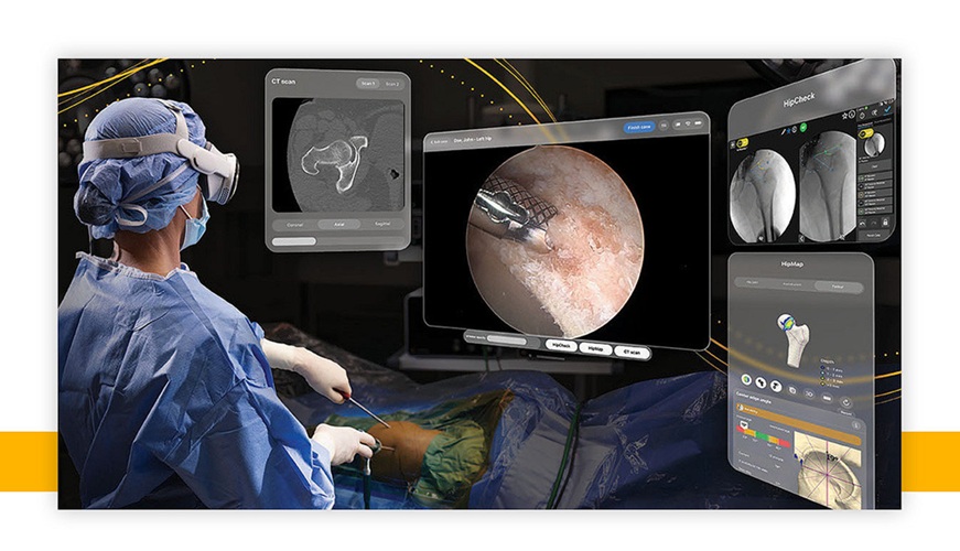 Imagen: SportSuite Vision integra video artroscópico, HipCheck, HipMap e imágenes de CT dentro de un entorno informático espacial personalizable, lo que permite a los cirujanos ver la anatomía y las herramientas digitales en un campo de visión ergonómico (Fotografía cortesía de Stryker)