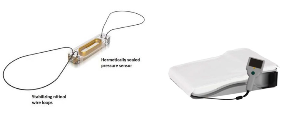 Imagen: El sistema CardioMEMS HF mide la PAP a través de un sensor implantado permanentemente en la arteria pulmonar. (Crédito de la imagen: Administración de Alimentos y Medicamentos de EE. UU.)