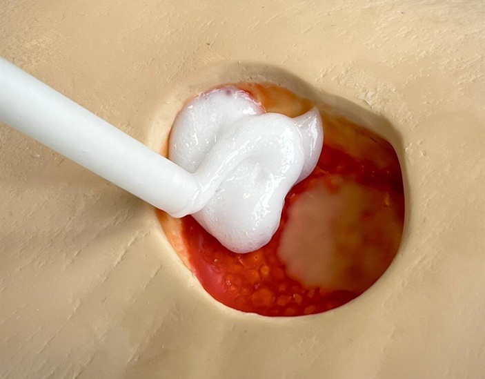 Imagen: La mezcla de silicona líquida se inyecta directamente en la herida profunda utilizando una pistola de calafateo. (Crédito de la imagen: AleSac)