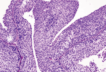 Imagen: Histopatología de un carcinoma urotelial de la vejiga urinaria a partir de una biopsia transureteral (Fotografía cortesía de Wikipedia).