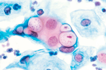 Imagen: Micrograma (500x) de una citología humana mostrando C. trachomatis en las vacuolas (Fotografía cortesía de Wikimedia Commons).