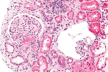 Imagen: Micrografía de una coagulación intravascular diseminada con microangiopatía trombótica aguda (Fotografía cortesía de Nephron).