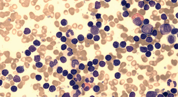 Imagen: Células de leucemia linfoide crónica en un extendido de medula ósea (Fotografía cortesía del Foro de Leucemia Linfoide Crónica del Reino Unido).