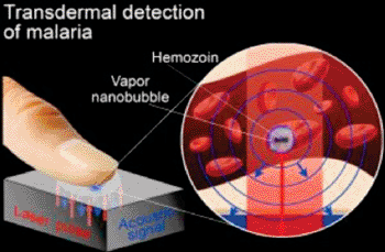 Imagen: Una gráfica que muestra la forma en que el pulso de láser crea una nanoburbuja de vapor en una célula infectada por malaria y se usa no invasivamente para diagnosticar la malaria rápidamente y con una alta sensibilidad (Fotografía cortesía de E. Lukianova-Hleb/Universidad de Rice).