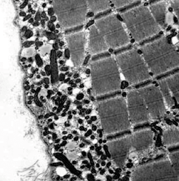 Imagen: Microfotografía electrónica mostrando un incremento en el número de mitocondrias en el espacio subsarcolemal de un paciente con una miopatía mitocondrial (Fotografía cortesía de la Universidad del Commonwealth de Virginia).