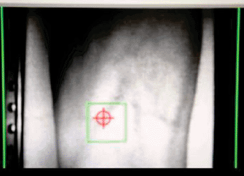 Imagen: El dispositivo médico automatizado portátil para venipunción, VenousPro, identificando una vena adecuada para flebotomía (Fotografía cortesía de VascuLogic).