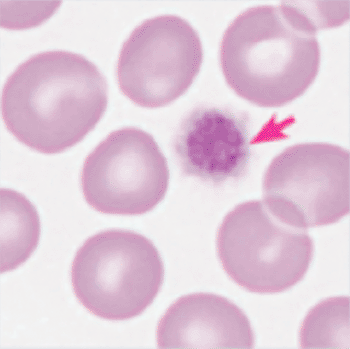 Imagen: Una plaqueta gigante en un extendido de sangre (Fotografía cortesía de Sysmex).