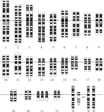 Imagen: Cariotipo para la trisomía del síndrome de Down, mostrando las tres copias del cromosoma 21 (Fotografía cortesía de Wikimedia Commons).