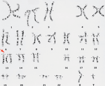 Imagen: Una prueba de cromosomas fetales mostrando la trisomía 13, indicada por las flechas rojas (Fotografía cortesía del Instituto Nacional de Investigación del Genoma Humano).