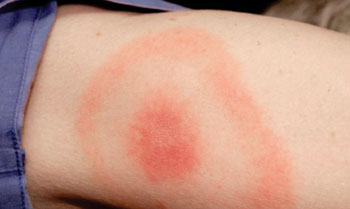 Imagen: La erupción de la enfermedad de Lyme, llamada eritema migrans en el sitio de la picadura de una garrapata  en el brazo superior derecho posterior de una mujer (Fotografía cortesía de James Gathany).