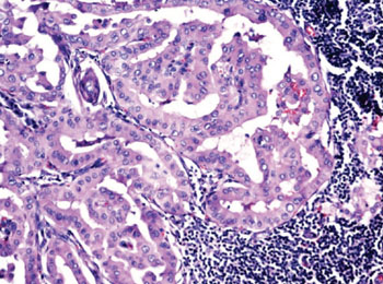 Imagen: Fotomicrografía de una variante de célula alta de metástasis de un carcinoma papilar de tiroides en los ganglios linfáticos axilares (Fotografía cortesía del Dr. Arvind Krishnamurthy).