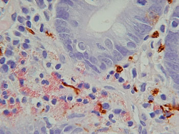 Imagen: Una histopatología mostrando la degranulación de los eosinófilos (rosa) con nervios adyacentes (marrón) en el duodeno de un paciente con enfermedad intestinal funcional (Fotografía cortesía de la Dra. Marjorie Walker).