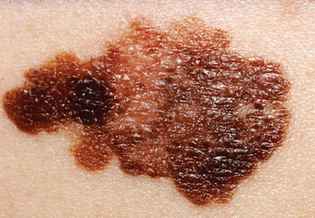 Imagen: Un melanoma en la piel de un paciente (Fotografía cortesía del Instituto Nacional de Cáncer de los EUA).