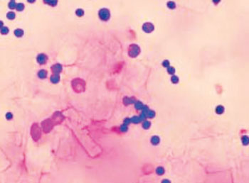 Imagen: Citología del líquido pericárdico mostrando cristales rectangulares, abundantes, que corresponden a cristales de colesterol y células inflamatorias compuestas por linfocitos y macrófagos (Fotografía cortesía de la Dra. Mercedes Camprubí).