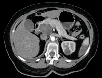 Imagen A: Un adenocarcinoma quístico en la cabeza del páncreas; cortes transversal de una TC con inyección de contraste i.v. (Fotografía cortesía de Wikimedia).