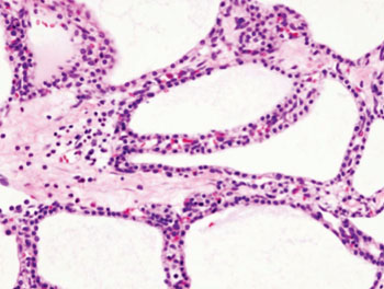 Imagen B: Imagen histopatológica de un quistoadenoma seroso del páncreas, coloración de H & E (Fotografía cortesía de Wikimedia).