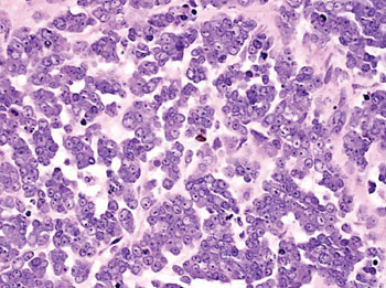 Imagen: Histopatología de un carcinoma de células pequeñas del ovario, tipo hipercalcémico; las células tumorales forman arreglos como nidos pequeños (Fotografía cortesía del Dr. Dharam Ramnani).