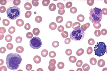 Imagen: Leucocitos teñidos en un frotis de sangre periférica (Fotografía cortesía de la Dra. Kristine Krafts, MD).