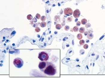 Imagen: Inmunocloración de tejido pulmonar humano, fijado con HOPE, de pacientes que sufren la enfermedad de los Legionarios. Se pueden detectar una proteína de la legionella (rojo-pardo), las vacuolas que contienen las bacterias y la legionella individual en la célula limpidora. El proceso infeccioso puede ser observado inmediatamente usando proteómica (Fotografía cortesía de la Universidad Braunschweig de Tecnología).