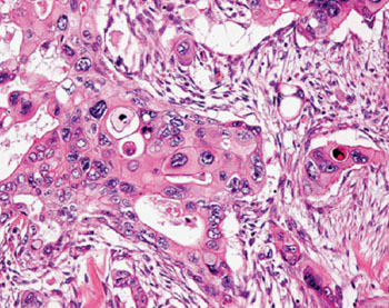 Imagen B: Fotomicrofotografía de un carcinoma adenoescamoso humano (Fotografía cortesía de Ralph H Hruban and Noriyoshi Fukushima).