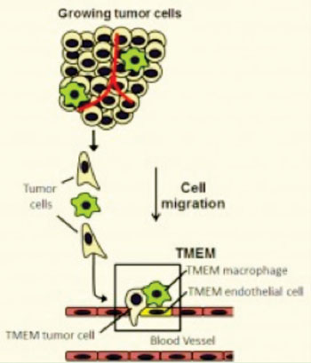 Imagen: La metástasis requiere la presencia de tres células en contacto directo en la pared del vaso sanguíneo: una célula tumoral que produce la proteína MENA; un macrófago perivascular (células que guían las células tumorales a los vasos sanguíneos) y una célula endotelial de los vasos sanguíneos. La presencia de tres células de este tipo en contacto con otra es llamada un microambiente tumoral de metástasis o TMEM, que se muestra en la caja en esta ilustración (Fotografía cortesía de la Facultad de Medicina Albert Einstein de la Universidad Yeshiva).