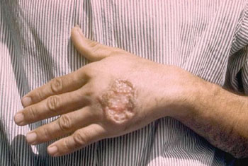 Imagen B: Lesión de leishmaniasis cutánea en la mano (Fotografía cortesía de D.S. Martin).