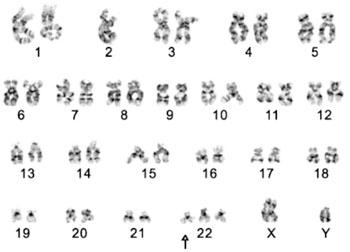 Imagen: Cariotipo de la trisomía 22 mostrando tres copias del cromosoma 22 (Fotografía de la Facultad de medicina de la Universidad Femenina Ewha).