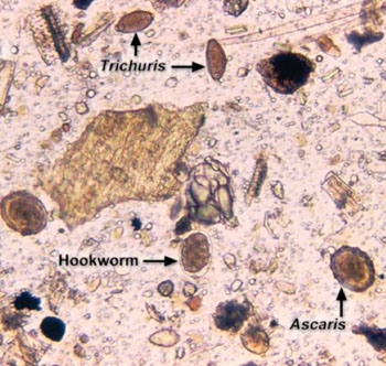 Imagen B: Fotomicrografía de Ascaris sp., Trichuris sp., y huevos de Tenia en una muestra de heces (Fotografía cortesía de la Dra. Mae Melvin).