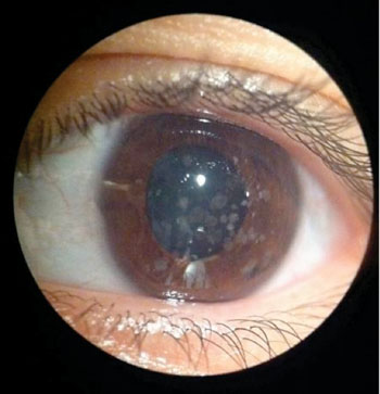 Imagen: Distrofia corneal granular (Fotografía cortesía del Dr. B.H. Feldman).