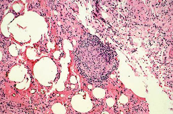 Imagen: Histología de un tejido pulmonar de un pacientes con beriliosis crónica, mostrando tejido granulomatoso (Fotografía cortesía de la Clínica Cleveland).