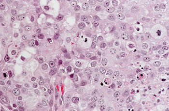 Imagen: Histopatología de un carcinoma se mama ductal, invasivo, de alto grado (Fotografía cortesía de la Universidad Johns Hopkins).