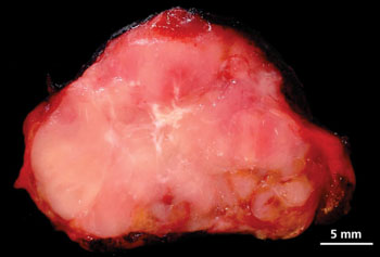 Imagen: Un cáncer papilar de tiroides mostrando un tumor gris lobulado con una cicatriz central (Fotografía cortesía del Dr. Shahidul Islam).