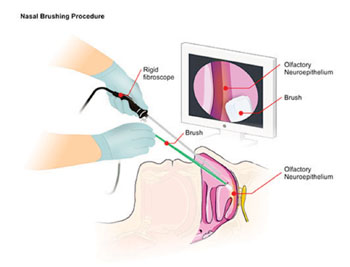 Imagen: La prueba de cepillado nasal implica la inserción de un rinoscopio rígido, de fibra óptica, dentro de la cavidad nasal del paciente. Posteriormente se inserta un cepillo estéril a lo largo del fibroscopio para recolectar neuronas olfatorias enrollando suavemente el cepillo a lo largo de la superficie de la mucosa (Fotografía cortesía del Dr. Gianluigi Zanusso, MD, PhD).
