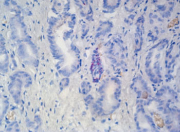 Imagen: El ARNscopio detecta la expresión del mARN TP63 en el tejido prostático humano (Fotografía cortesía de Advanced Cell Diagnostics).