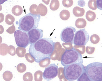 Imagen: Microfotografía de un frotis de sangre de un paciente con leucemia linfocítica crónica atípica. Los linfocitos eran principalmente pequeños y tenían núcleos redondos, cromatina condensada y escaso citoplasma. Aproximadamente el 20% de los linfocitos tenía las características morfológicas de los prolinfocitos como cromatina finamente dispersa y un nucléolo central (flechas) (Fotografía cortesía de la Sociedad Norteamericana de Hematología).