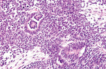 Imagen B: Histopatología de un riñón que muestra el patrón trifásico característico, consistente en túbulos, hojas sólidas de células redondas pequeñas y estroma de un tumor de Wilms (Fotografía cortesía de la revista Nephron)