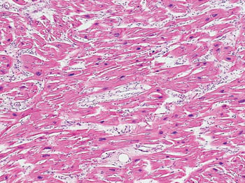 Imagen: Una histopatología de un corazón que muestra fibrosis y desarreglo miocárdico en una cardiomiopatía hipertrófica de un caso de paro cardiaco súbito (Fotografía cortesía de Candace H. Schoppe, MD).