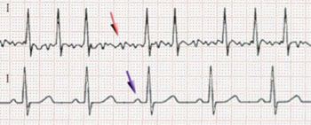 Imagen: Un ECG de un caso de fibrilación auricular (arriba) y un ritmo sinusal normal (abajo). La flecha púrpura indica una onda P, la cual se pierde en la fibrilación auricular (Fotografía cortesía de Wikimedia Commons).