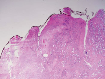Imagen A: Cáncer de próstata GS3. El tejido sigue teniendo glándulas reconocibles pero las células son más oscuras. A gran aumento, algunas de estas células han abandonado las glándulas y están comenzando a invadir el tejido circundante o a tener un patrón inflitrativo. Esto corresponde a un carcinoma moderadamente diferenciado (Fotografía cortesía de Wikimedia Commons).