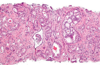 Imagen B: Cáncer de próstata GS4. El tejido tiene pocas glándulas reconocibles. Muchas células están invadiendo el tejido circundante en acúmulos neoplásicos. Esto corresponde a un carcinoma pobremente diferenciado. (Fotografía cortesía de Wikimedia Commons).