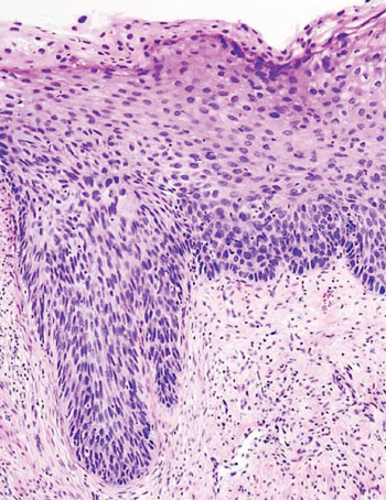Imagen: Histopatología de una neoplasia intraepitelial cervial (NIC3), mostrando una displasia severa que abarca más de las 2/3 del epitelio y puede involucrar el espesor completo. En algunas ocasiones se puede hacer referencia a la lesión como carcinoma cervical in situ (Fotografía cortesía de KGH/Wikipedia Commons).