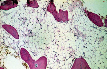 Imagen: Una fotomicrografía de una biopsia de medula ósea hipoelular, debido a la falta de células hematopoyéticas, de un paciente con anemia aplástica (Fotografía cortesía de la Universidad Autónoma de Zacatecas).