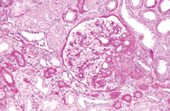 Imagen: Una microfotografía en gran aumento de la glomeruloesclerosis segmental focal (FSGS) (Fotografía cortesía de Wikimedia Commons).