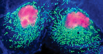 Imagen: La autofluorescencia inducida en el cercano ultravioleta muestra diferencias significativas entre el tejido tumoral y el sano (Fotografía cortesía de la Dra. Geneviève Bourg-Heckly).
