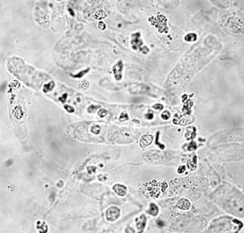 Imagen B: Una fotomicrografía de una muestra de orina con muchos cilindros hialinos y celulares entremezclados entre sí (Fotografía cortesía de la Universidad Católica de Corea).