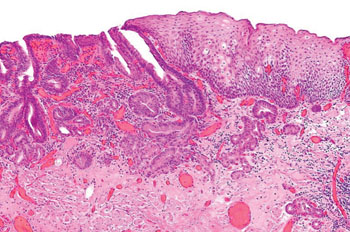 Imagen: Una microfotografía histológica de un adenocarcinoma de esófago obtenida de una resección endoscópica de la mucosa (Fotografía cortesía de Nephron).